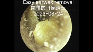 Easy earwax removal简单的耳屎清理20230824 [upl. by Estrellita]