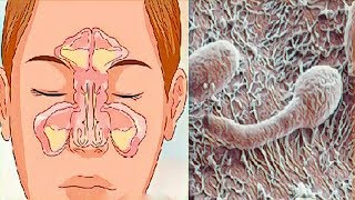 ¿Nariz obstruida rinitis o sinusitis Sepa cómo resolver [upl. by Esyak]