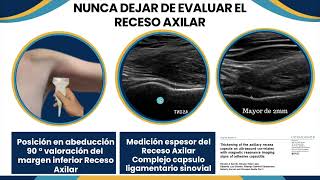 Como evaluar el hombro doloroso en capsulitis adhesiva Dr Guillermo Azulay [upl. by Dylana]