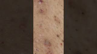 Bikini Ingrown hair removal See Transformation [upl. by Ellimahs386]