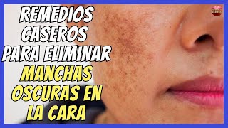 🩷 REMEDIOS CASEROS PARA ELIMINAR MANCHAS OSCURAS EN LA CARA 🩷 [upl. by Georg]