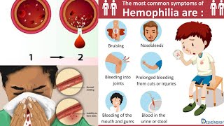 Hemophilia  Introduction Clinical Features Investigation and Management [upl. by Hbahsur312]