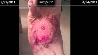 2nd Degree burns on foot  healing time lapse  2 months [upl. by Charity60]