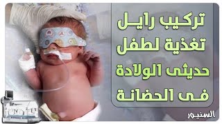 تعلم تركيب رايل التغذيه للاطفال حديثي الولاده من الفم للمعدهorogastric tube insertion procedure [upl. by Aurelius801]