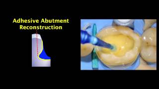 Indirect Posterior Resin Composite Restorations  Adhesive Abutment Reconstruction [upl. by Leighland204]