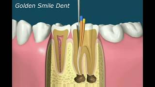 Kanal Tedavisi Nasıl Yapılır  GoldenSmileDent [upl. by Macegan331]