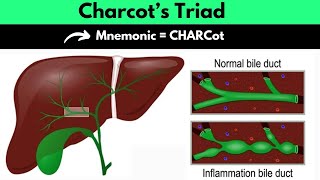 Charcot’s Triad Mnemonic  Charcot’s Triad For Ascending Cholangitis Mnemonic  Dr Mubashar Ata [upl. by Eedeed]