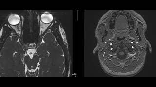 case 22 diplopia and squint [upl. by Aikim888]