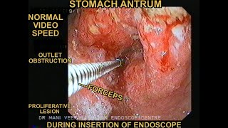 GASTRIC OUTLET OBSTRUCTION DUE TO CANCER STOMACH [upl. by Woody]