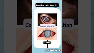 Acanthamoeba keratitis neetpg usmle ophthalmology [upl. by Polito]