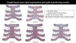 Thoracic Cartilage UltrasoundCT Registration using Dense Skeleton Graph [upl. by Allveta]