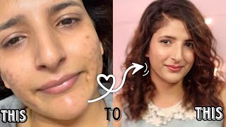 How to get rid of acne scars and acne acnetreatment pimple homeskincare [upl. by Pembroke782]