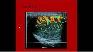 full story orchitisepidydmitisepidydmo orchitis imaging Dr Ahmed Esawy [upl. by Ynnahc]