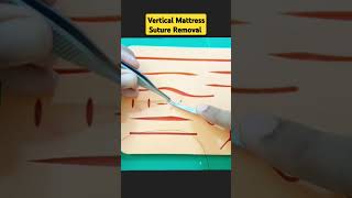 Vertical Mattress Suture Removal [upl. by Jewel]