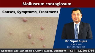 Molluscum contagiosum  Causes Symptoms Treatment [upl. by Randy]