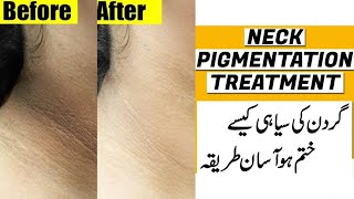 Dark Neck Removal l How to Get Rid Of Dark Neck At Home In Just 20min Get CLEAR White Neck [upl. by Dempsey]