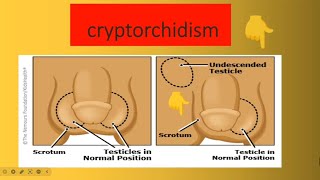 Cryptorchidism [upl. by Emilio822]