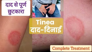 Tinea Cruris  Ringworm  दाद दिनाई का complete Treatment tinea ringworm jockitch Daad ka ilaj [upl. by Karab410]