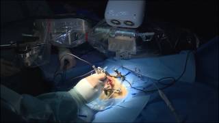 RobotAssisted Cochlear Implantation [upl. by Macmullin103]