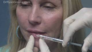 Lip Augmentation with Juvederm Injection  Fort Lauderdale [upl. by Traweek]