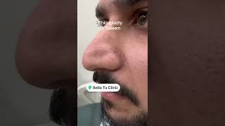 Rhinoplasty surgery for wide amp thick nose in Pakistan [upl. by Saffier310]