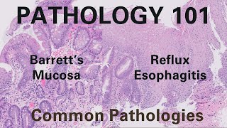 Reflux Esophagitis amp Barretts Esophagus  Pathology 101 [upl. by Eiroc916]