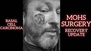 Before and After My Skin Cancer Basal Cell Carcinoma Mohs Surgery 6 month Update [upl. by Astrea]