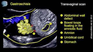 Gastroschisis [upl. by Yelsnya943]