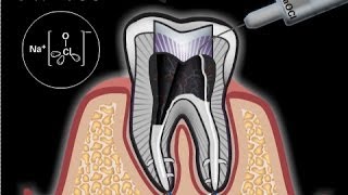 Was ist eine Wurzelbehandlung [upl. by Ttennej35]