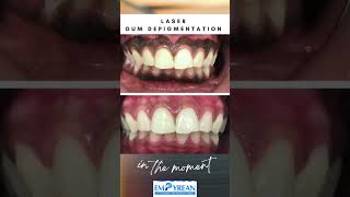 Depigmentation of Gums  Dark Coloured gums to pink shorts viralvideo dental trending gums [upl. by Assecnirp]