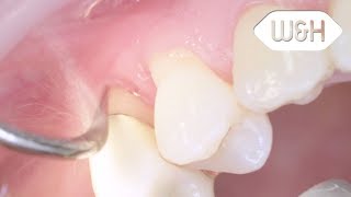 Proxeo Air Scaler and periodontology tips 1AP 2API English [upl. by Yhtir]