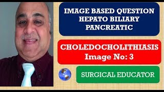 CHOLEDOCHOLITHIASIS  Hepato Biliary Pancreatic Image 3 [upl. by Inobe]