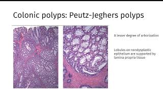 GI polyps GIPATH [upl. by Itraa]