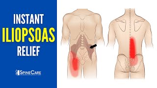 How to Instantly Relieve Iliopsoas Muscle Tightness AND PAIN [upl. by Llenrep210]