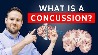 What is a Concussion  Concussion Patient Education Series  Ep 1 [upl. by Heidy]