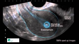 INSTITUT MARQUÈS  I movimenti dellutero favoriscono limpianto dellembrione [upl. by Richman]