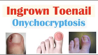 Ingrown Toenail Onychocryptosis  Causes Risk Factors Signs amp Symptoms Diagnosis Treatment [upl. by Sukey53]