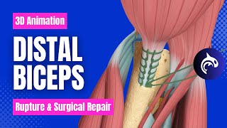 Distal Biceps Rupture and Surgical Repair  3D Animation [upl. by Silva]