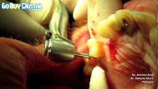 Straumann Compatible BioconceptDental Implant Surgery Step by Step V3 [upl. by Elleined]