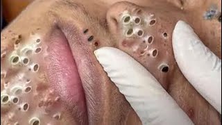 ASMR NOSE BLACK HEAD REMOVAL Relaxing View [upl. by Tratner920]