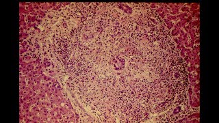 Primary Biliary Cirrhosis  Pathology mini tutorial [upl. by Africah]