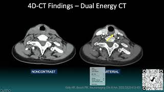 2022  Parathyroid Imaging Strategies  Hillary Kelly [upl. by Normak]