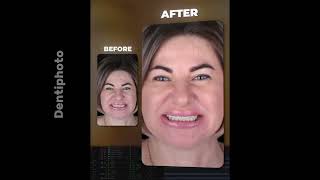 Dental Photography Course After Effects Editing [upl. by Sherburne]