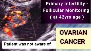 Ultrasound Infertility  Ovarian Cancer [upl. by Doroteya]