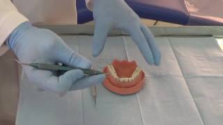 Eliminación cálculo dental mediante el uso de curetas [upl. by Mehitable]