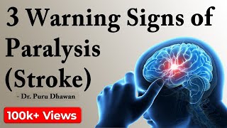 3 Warning Signs of Paralysis Stroke [upl. by Africah132]