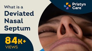 What is a Deviated Nasal Septum  Treatment for DNS [upl. by Giffard]