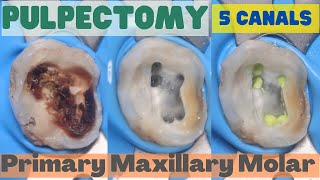 Pulpectomy ⚪️ PRIMARY MAXILLARY MOLAR 🟡 5 Canals 🔵 step by step demonstration [upl. by Navy644]