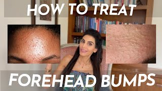 How to Treat Tiny Little Bumps on the Forehead [upl. by Eleanor]