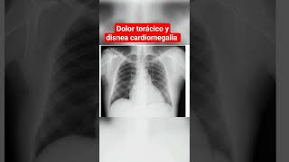 CARDIOMEGALIA DOLOR TORÁCICO Y DISNEA [upl. by Zennas653]